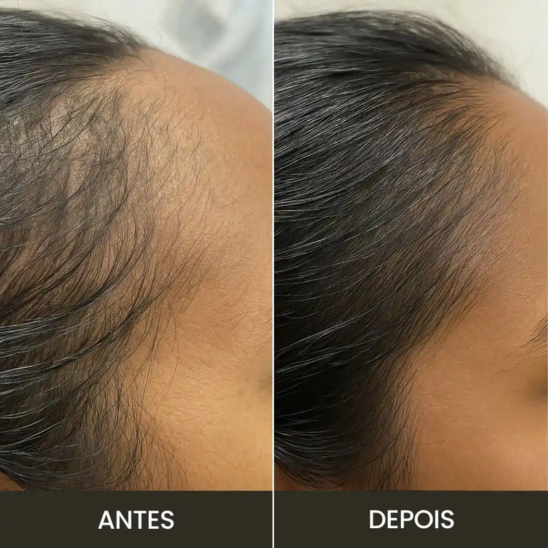 Escova de Terapia Capilar